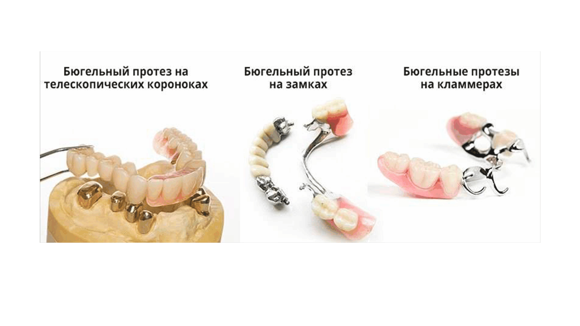 Бюгельные зубные протезы | что это такое, показания и противопоказания, плюсы и минусы